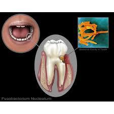 Fusobacterium nucleatum Batterio gram-negativo Risiede principalmente nella cavità orale umana Svolge un ruolo significativo nello sviluppo della malattia parodontale e gengivite La sua presenza nel