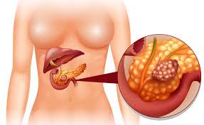 Cancro Pancreas Rappresenta la quarta causa di morte nel sesso femminile(7%) Sesta nel sesso maschile