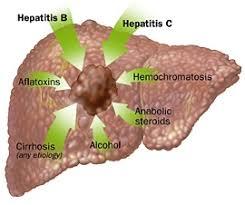 Epatocarcinoma Virus epatite B e C Fattori di rischio Steatosi