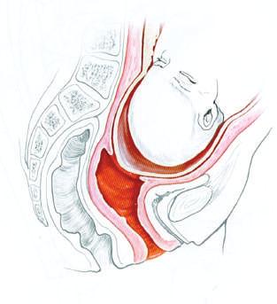 Talvolta le contrazioni non sono abbastanza frequenti ed intense e può essere necessaria la somministrazione dell ossitocina per via endovenosa.