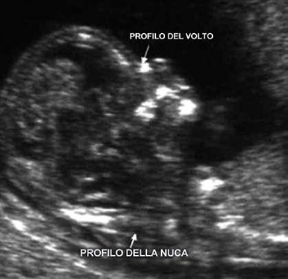 PERCORSO SCREENING PRENATALE screening prenatale Gli esami cosiddetti di screening prenatale calcolano il rischio personale delle più comuni alterazioni cromosomiche (quali la trisomia 21 detta anche