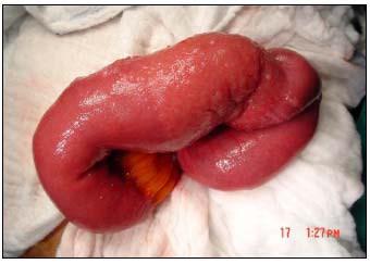 A Figura 21: A Digiuno distale asportato a seguito di ostruzione intestinale B Rilievo istopatologico: mucosa ileale con infiltrato di eosinofili attorno alla larva di Anisakis (Dong Baek