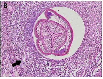 , 2008) FORME EXTRA-GASTROINTESTINALI O ECTOPICHE Le forme extra-gastrointestinali si riscontrano quando il parassita riesce a perforare la parete gastrointestinale per migrare negli