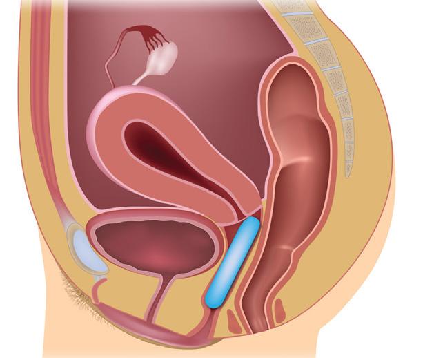 Cistocele, enterocele, rettocele e uretrocele Il prolasso del retto (rettocele), dell intestino tenue (enterocele), della vescica (cistocele) e