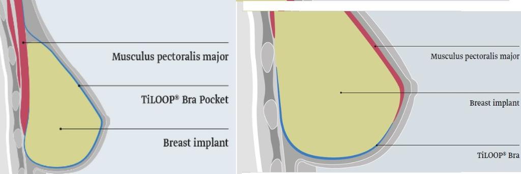 La rete protesica TiLOOP Bra Pocket è costituita da una maglia protesica a pori larghi e non riassorbibile, realizzata in polipropilene monofilamento con rivestimento in titanio.