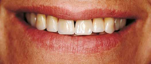 MYERSON SPECIAL Carta Forme Denti in resina > PAGE 3 Vedi la