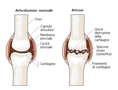 Le cause specifiche del dolore L'artrosi è una malattia cronica che colpisce le articolazioni.