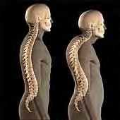 ATTEGGIAMENTO CIFOTICO È l aumento della curva fisiologica dorsale a convessità posteriore, che determina una postura con il dorso curvo.
