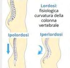 La lordosi risulta patologia anche in caso di Ipolordosi, ovvero un eccessiva riduzione della colonna vertebrale