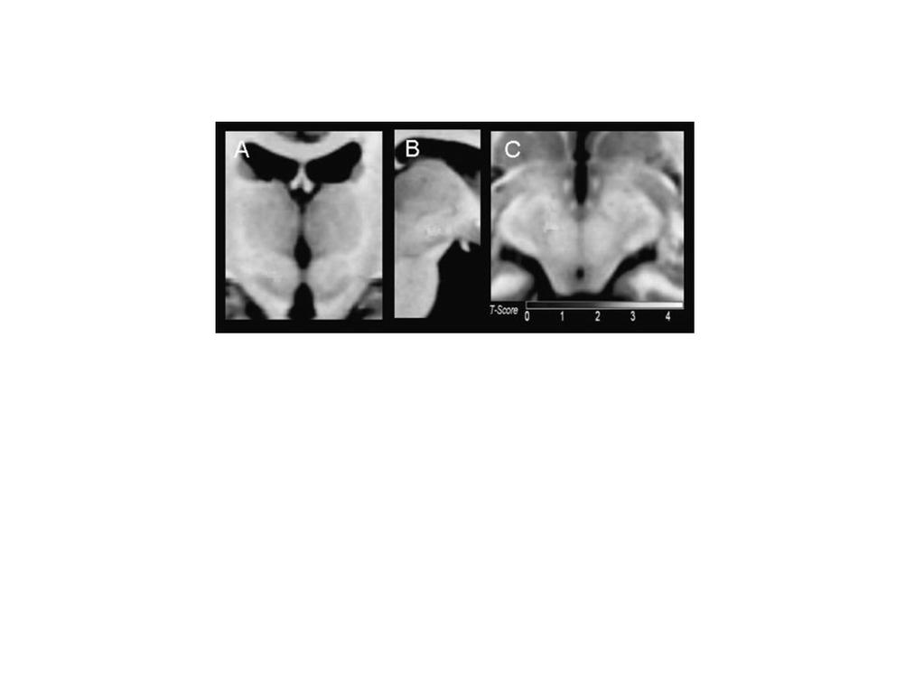 Clinical features, polysomnography and outcome in patients with hypnic headache Liang J-F, Fuh J-L, Yu C-Y, Wang S-J (Cephalalgia 28:209-215;2008) Polisonnografia in 11 pazienti registrati in 7