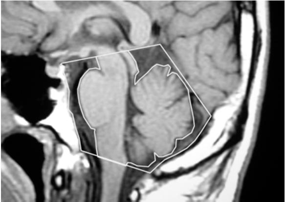 4.1 CEFALEA DA TOSSE PRIMARIA Criteri diagnostici (ICHD-3, 2018) A. Almeno 2 episodi di cefalea che soddisfano i criteri B-D B.