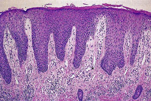 epidermide derma Atrofia cutanea Cortisonici