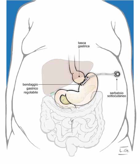 del sistema (3%). I risultati in termini di calo ponderale sono valutabili intorno al 40-50% dell eccesso di peso.