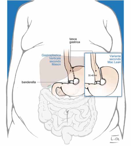 Gastroplastica verticale È il più antico degli interventi restrittivi e consiste nella partizione e riduzione del volume della sacca gastrica, mediante confezionamento di una tasca gastrica