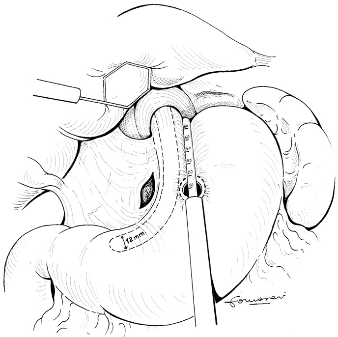 Dopo la sezione del legamento freno-gastrico e l esposizione del pilastro diaframmatico sinistro, si