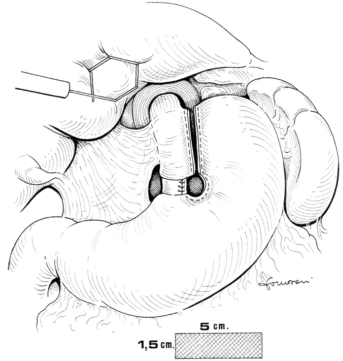 La procedura termina con la crezione del neo-piloro mediante una benderella, in genere, di