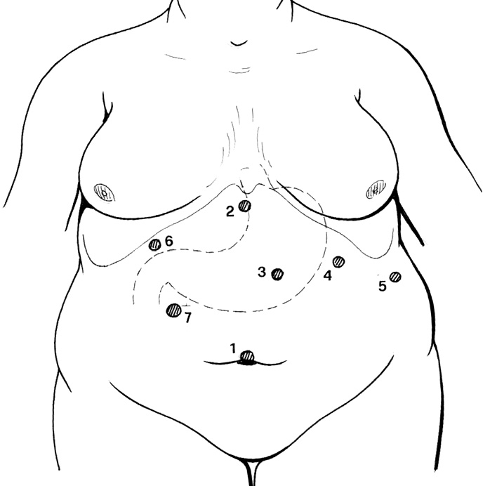 tecniche chirurgiche Fig. 9: Sleeve gastrectomy e diversione biliopancreatica con duodenal switch.