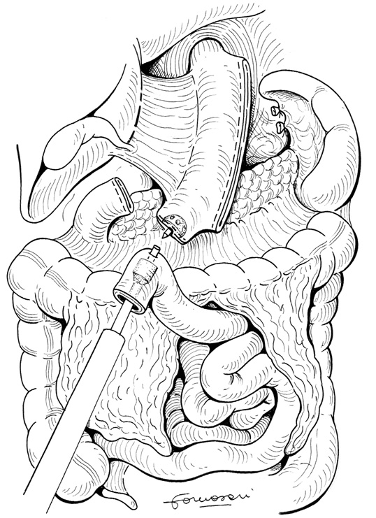 Per la sola sleeve gastrectomy sono sufficienti, in genere, 5 trocar.