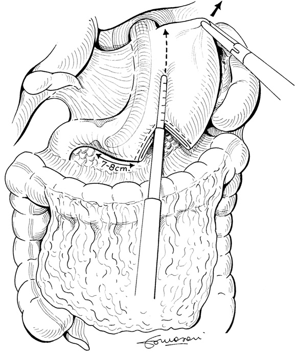 suturatrici lineari laparoscopiche, previa devascolarizzazione completa della grande curvatura.