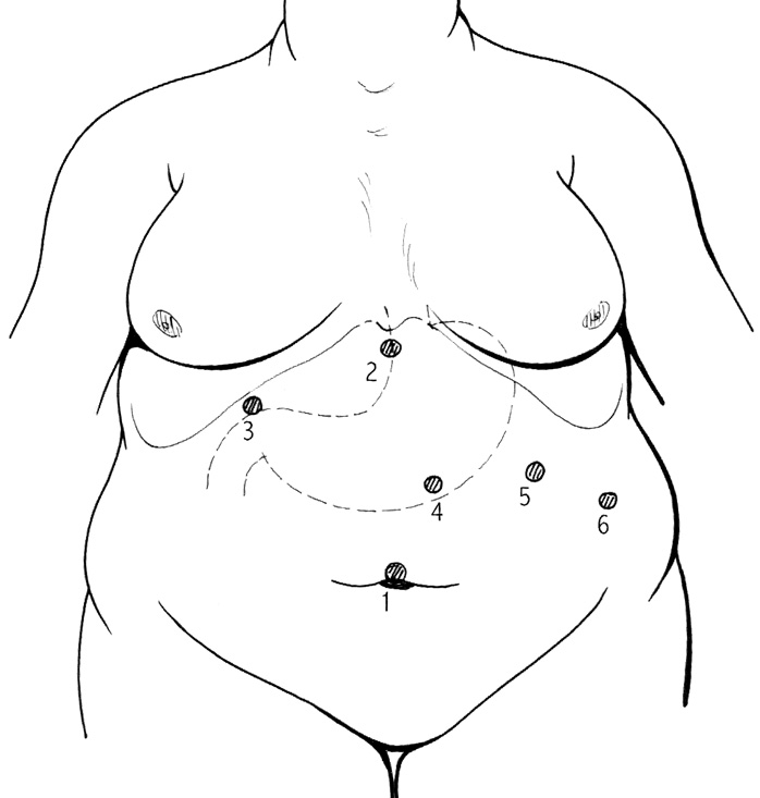 Fig. 10: Bypass gastrico laparoscopico. Nello schema viene riportata una abituale posizione dei trocar.