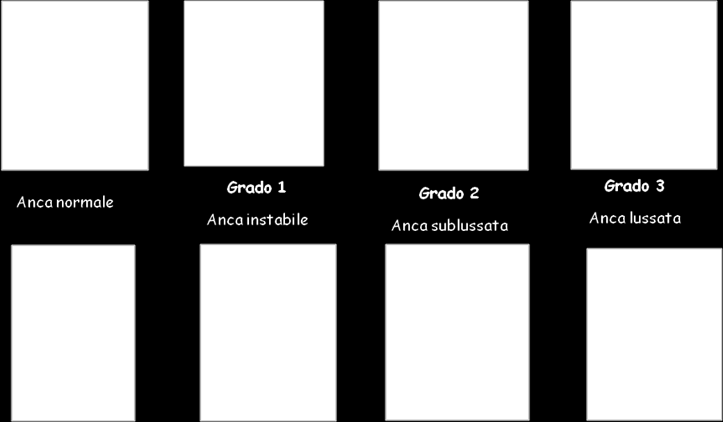 it Lo studio ultrasonografico delle anche infantili eseguito da esaminatori esperti con i moderni apparecchi ecografici oggi disponibili consente di descrivere con precisione e dettaglio la