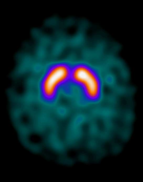 DD tra PD e con parkinsonismo iatrogeno è