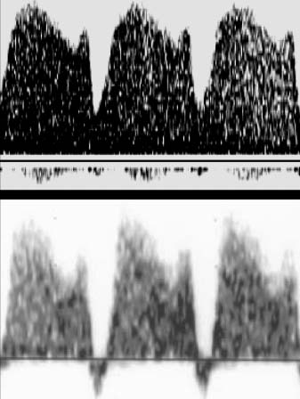 Figura 6. Onde velocimetriche nel dotto venoso fetale a 12 settimane di gravidanza che dimostrano una normale onda di flusso (sopra) ed un anomalia dell onda A (sotto).