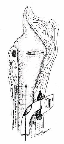 Le cannule possono essere: 1. Cannule cuffiate : quando la cannula è provvista di un palloncino esterno (cuffia) 