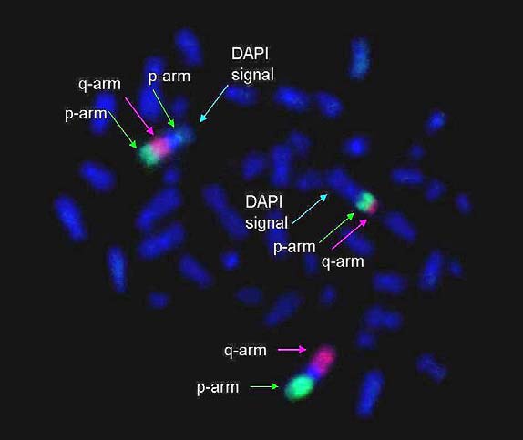 Fig. 55: Inter-intrascambio generato da 2 rotture sul cromosoma 1 (ciascuna su un braccio) e da una rottura su un cromosoma in DAPI.