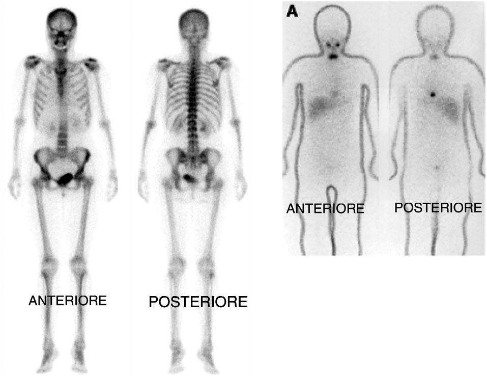 N. BELCARI E A. DEL GUERRA: UTILIZZO DI TECNICHE NUCLEARI NELL'IMAGING MOLECOLARE Fig. 4. ± Esempi di applicazioni SPECT in oncologia. A sinistra una scansione ossea ottenuta con 99m Tc.