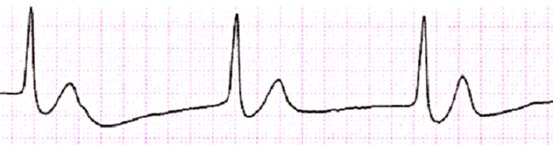 Alterazioni del miocardio atriale: ritmo giunzionale (circa 50 ) Alterazioni attività atriale e giunzionale: