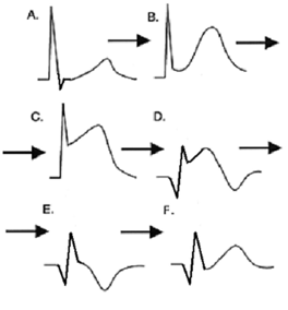 A. Aspetto normale DII B. Iniziale sopralivellamento ST (minuti) C. Evidente sopralivellamento ST, il QRS rimane invariato (ore) D. Compare l onda Q, l onda T è invertita.