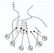 L'elettrocardiografo confronta i fenomeni elettrici registrati nelle diverse posizioni e trascrive sul tracciato.