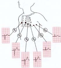 Si può supporre che le sei derivazioni standard, registrate dagli elettrodi fissati agli arti, guardino il cuore su un piano sagittale, di profilo (VL, DI, DII guardano il lato sinistro del cuore; VR