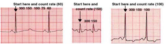 Interpretazione Frequenza (alta-bassa) Ritmo (regolare-irregolare) QRS (largo-stretto) Onde P (sì-no) P QRS (rapporto) ST-T e onde Q Frequenza La frequenza è il numero di battiti per minuto.