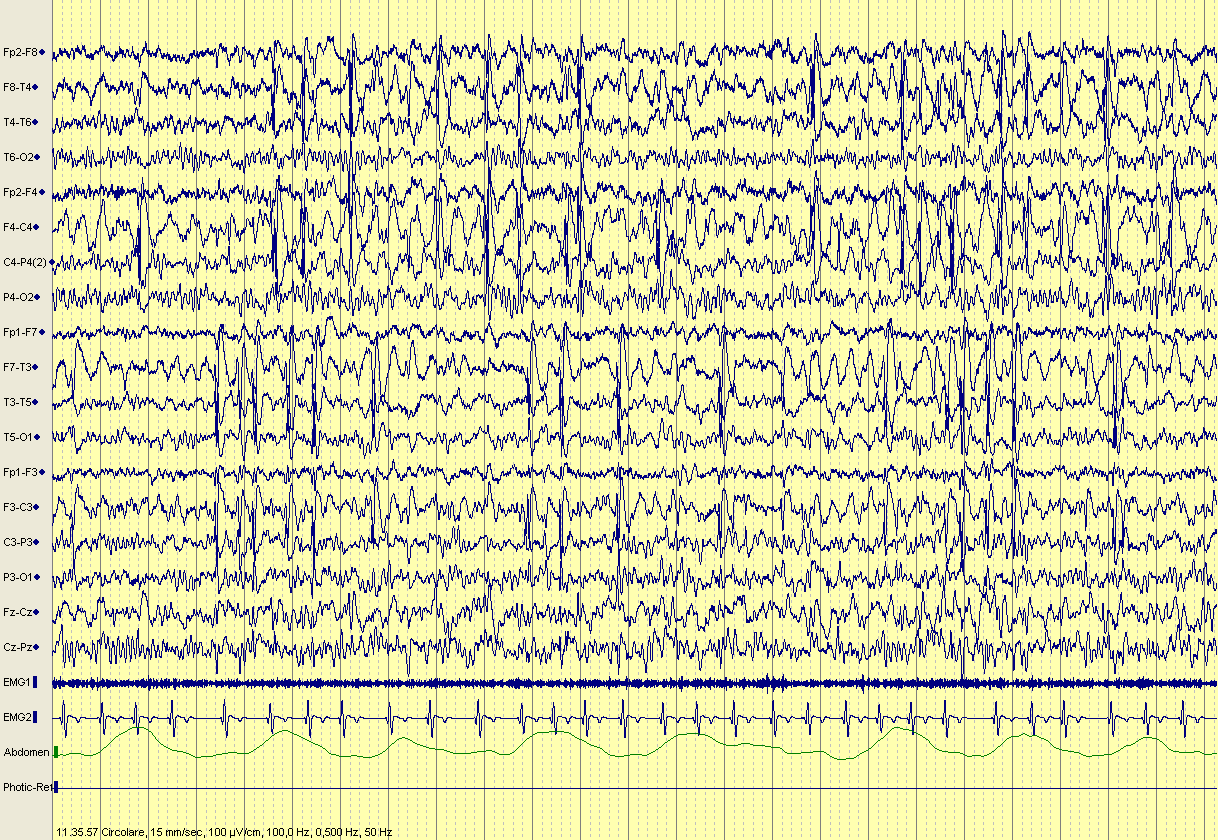 Capitolo 3 Risultati EEG 2012: attività di punta lenta seguita da onda in sede temporo-centrale bilateralmente, che in sonno si attiva diventando sub-continua. Non assume terapia (Fig. 15). Fig.