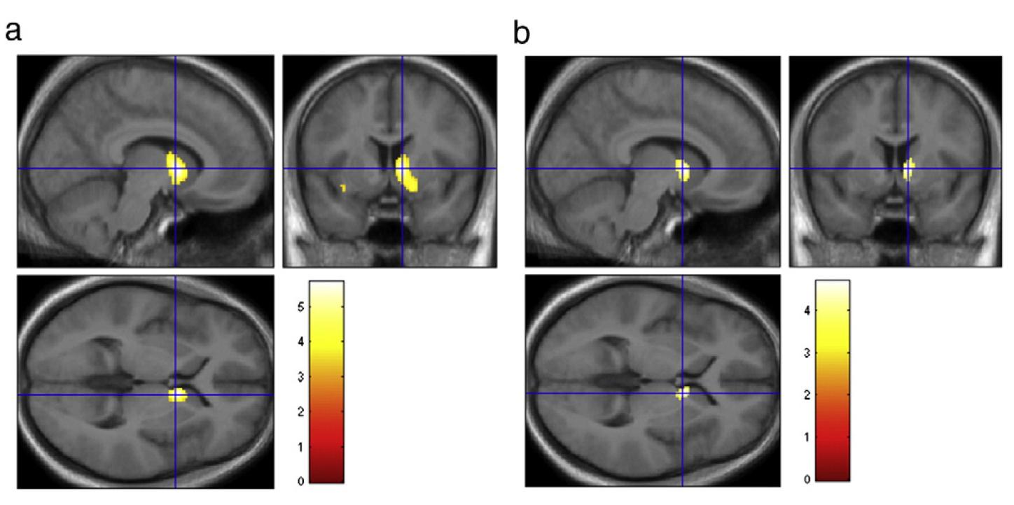 Pathological Gambling: more reward response =