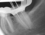 ON, Canada. radiografia, possono facilmente indurre il clinico a rimuovere per errore la dentina, anche laddove questo non è necessario ai fini della rimozione dello strumento.