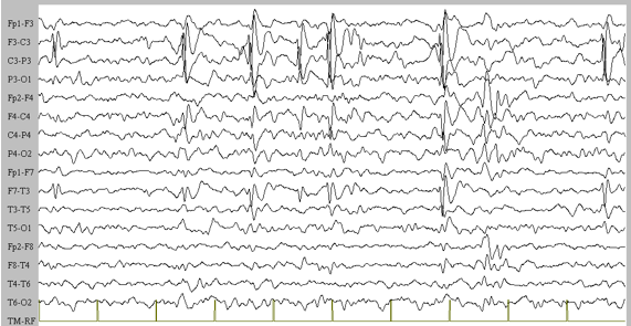 Epilessia parziale benigna dell infanzia a parossismi rolandici (EPR). E la forma di epilessia più frequente tra le epilessie infantili (20-23%).