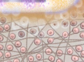 NUCLEOPLASTICA CON RADIOFREQUENZA (NPL) Coblazione