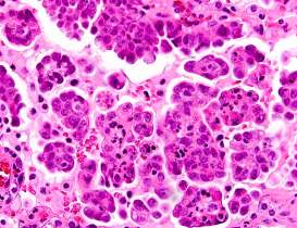 HER2/neu 20-25% Carcinoma mammella Trastuzumab K-RAS N-RAS adenocarcinoma del colon Cetuximab/panitunumab EGFR 20-25%