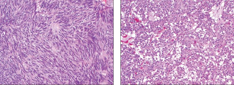 Cellule GIST fusate Cellule GIST epitelioidi Figura 4.