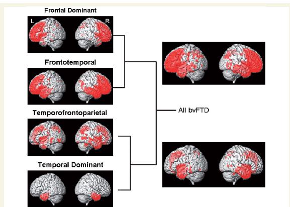 Whitwell et al Brain 2009 Tuttavia le principali modalita di presentazione non riescono ad essere differenziate tra di loro sulla base