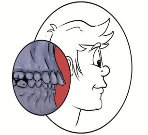 LE MALOCCLUSIONI: denti e ossa facciali malposizionate. 13 Che cosa sono le malocclusioni Malocclusione significa una cattiva chiusura dei denti. Le cause (eziologia) delle malocclusioni.