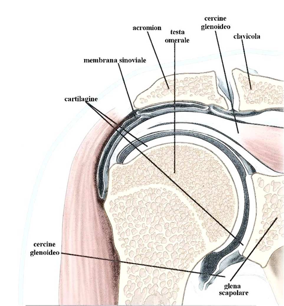 95% delle lesioni di cuffia trova la propria causa nel conflitto (impingement) subacromiale a cui è sottoposto il tendine del muscolo sovraspinoso nel suo passaggio sotto l arcata