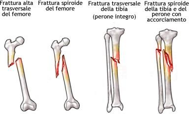 che cade nelle strutture La metà riporta frattura di