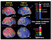 I primi studi gemellari 7 Erlenmeyer Kimling & Jarvik Science 1963 8 Differenze nella quantità di grigia nelle arre frontali, sensorimotorie e di Wernicke in gemelli MZ e DZ Correlazioni nella