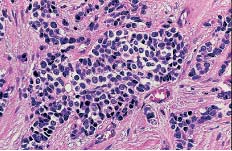 1-3), inizialmente definita eponimicamente come tumore di Askin (13) viene oggi considerata, insieme al sarcoma di Ewing, come parte dello spettro morfobiologico del tumore neuroectodermico primitivo