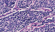 Oncogenesi ed integrazione diagnostica biomolecolare 31 Fig. 3: PNET: visibile la proliferazione di piccole cellule rotonde a citoplasma ricco di glicogeno PAS+.