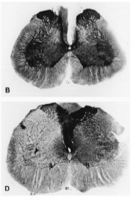 LESIONI NEUROTOSSICHE SELETTIVE Si avvalgono dell utilizzo di sostanze citotossiche, cioè in grado di uccidere le cellule una volta al loro interno.